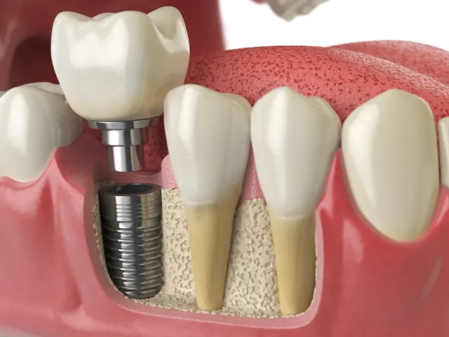 Long-term dental implant care consultation at Peninsula Dentistry in Huntington Beach