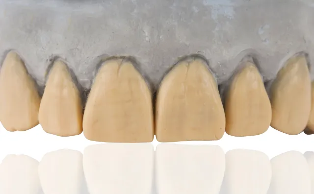 Porcelain dental veneers on a dental model showing natural-looking restoration