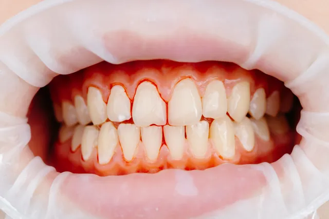 Close-up showing inflamed and bleeding gums indicating signs of gum disease