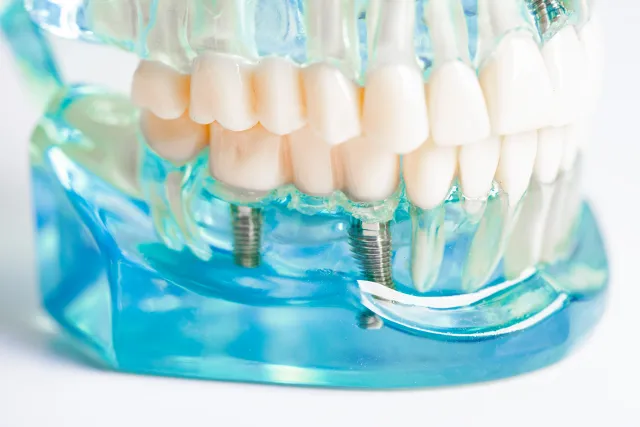 Dental implant model showing titanium post integrated into the jawbone