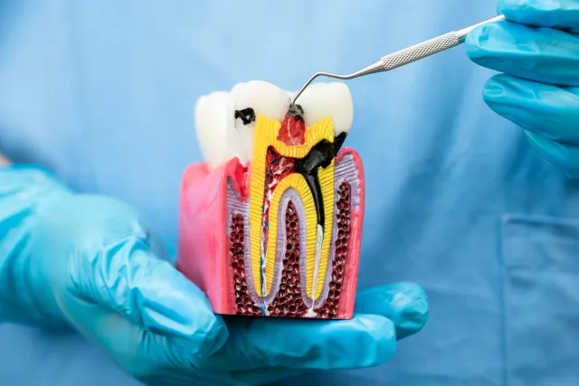 Dentist using an instrument on a tooth model to demonstrate root canal treatment