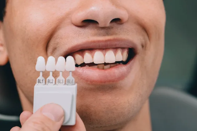 Dentist holding a teeth shade guide next to a patient's smile to compare whitening results