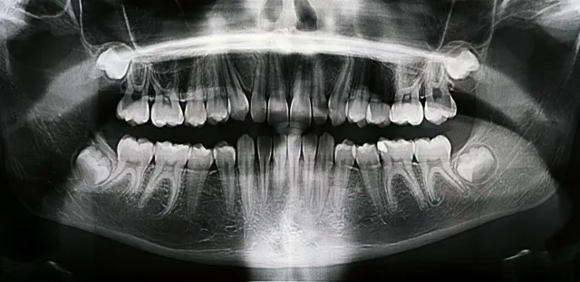 Panoramic dental X-ray showing wisdom teeth position in the jaw