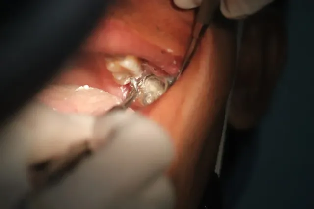 3D cone beam CT scan used to assess bone density before dental implant at Peninsula Dentistry Huntington Beach
