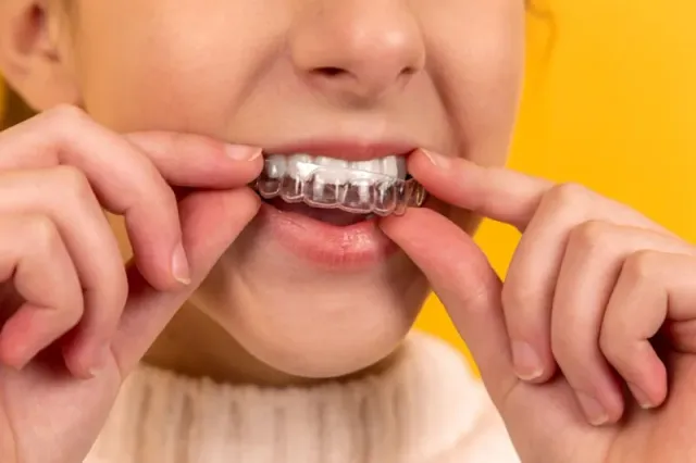 Custom dental nightguard for teeth grinding protection at Peninsula Dentistry in Huntington Beach