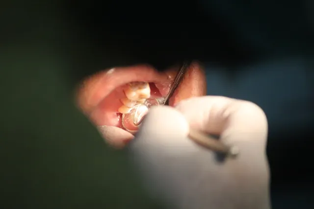 Tooth decay being examined before composite filling treatment at Peninsula Dentistry in Huntington Beach